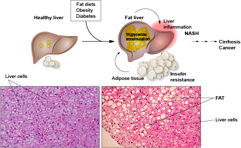 Fatty Liver and Metabolism